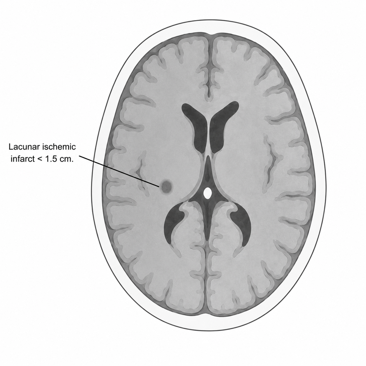 Esquema de infarto menor
