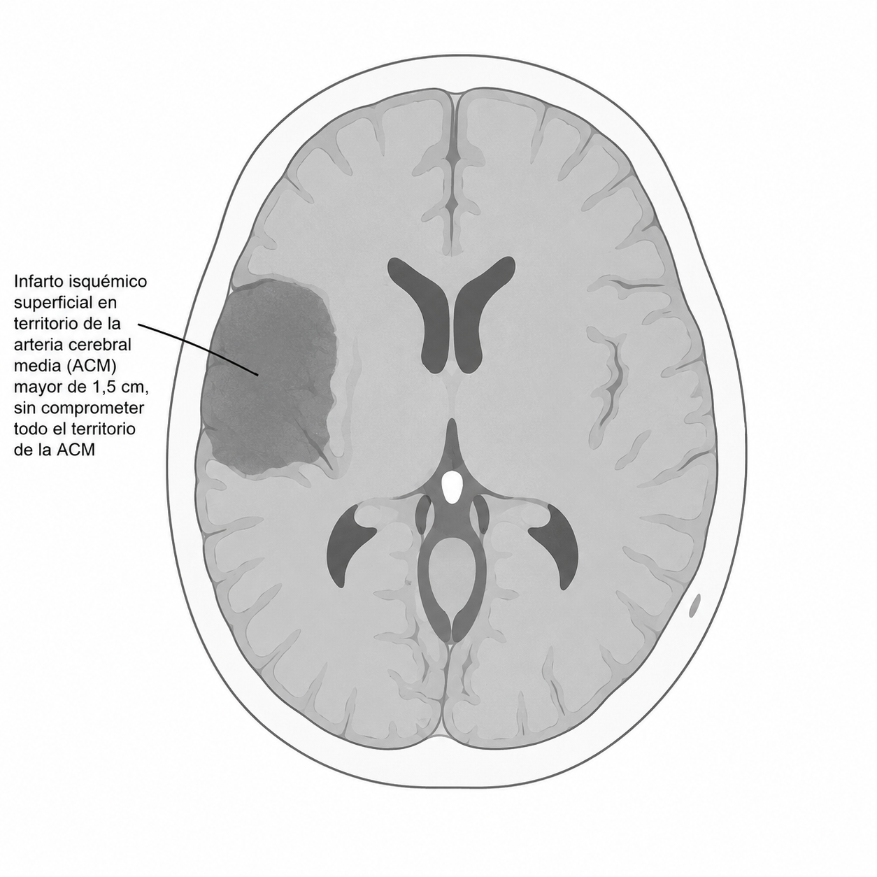 Esquema de infarto moderado