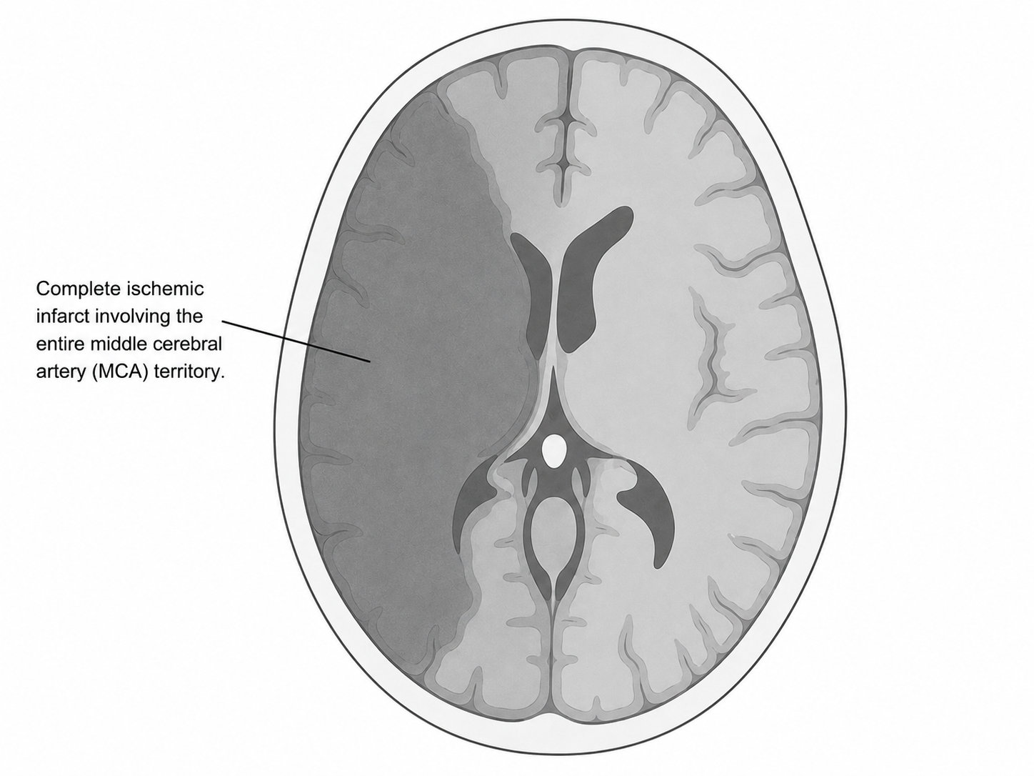 Esquema de infarto mayor 1