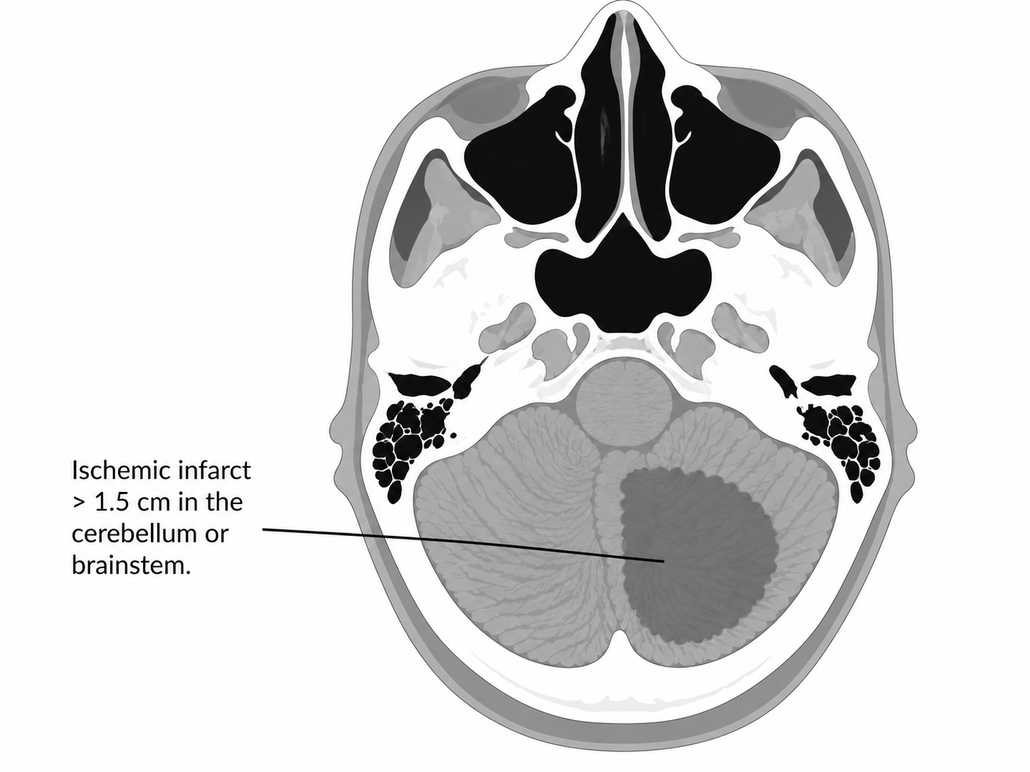Esquema de infarto mayor 2